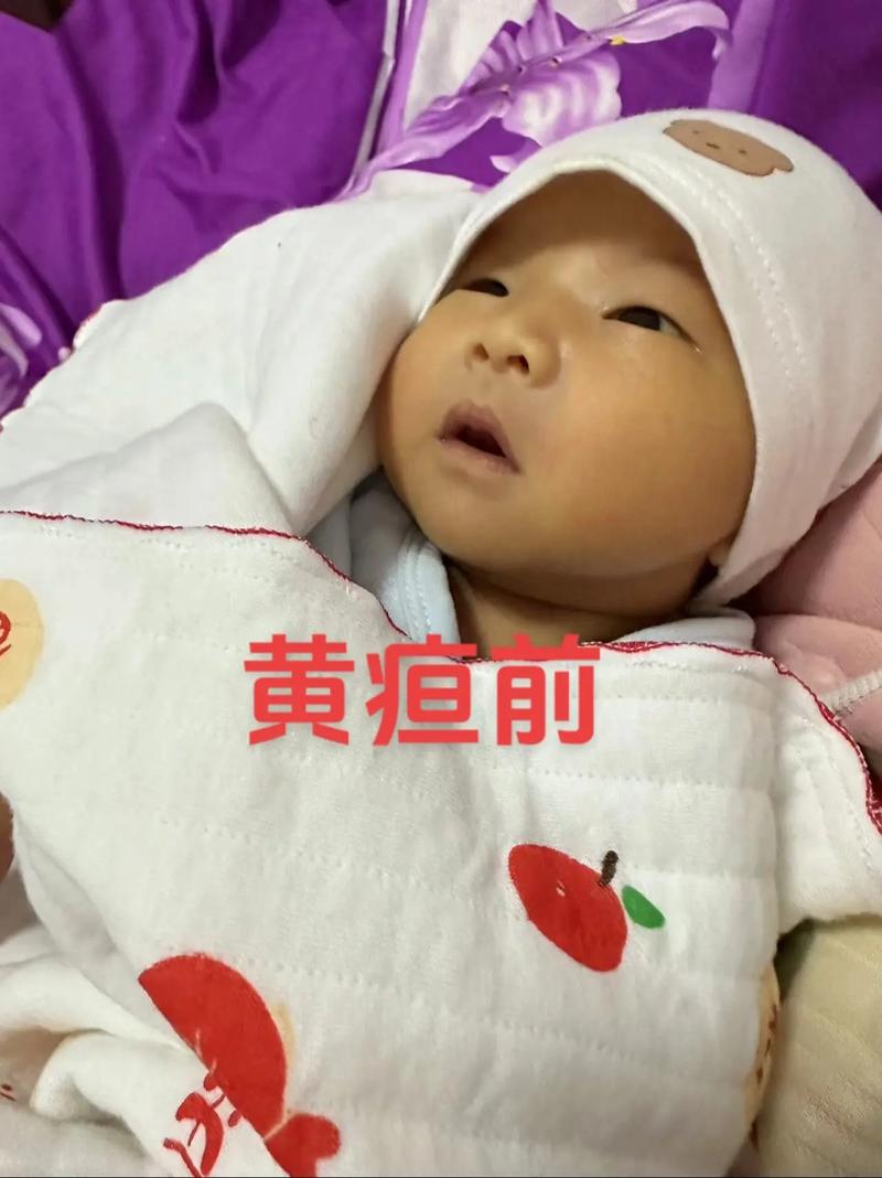 新生儿20多天黄疸还没退，是病理性黄疸还是喂养方式有问题？-第1张图片-郑州医学网