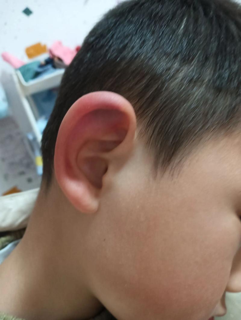 儿童耳朵红肿是过敏还是感染？家长该如何正确处理和护理？-第2张图片-郑州医学网