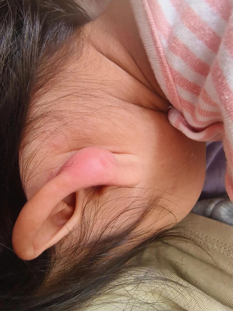 儿童耳朵红肿是过敏还是感染？家长该如何正确处理和护理？-第1张图片-郑州医学网