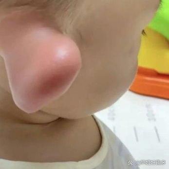 儿童耳朵红肿是过敏还是感染？家长该如何正确处理和护理？-第3张图片-郑州医学网
