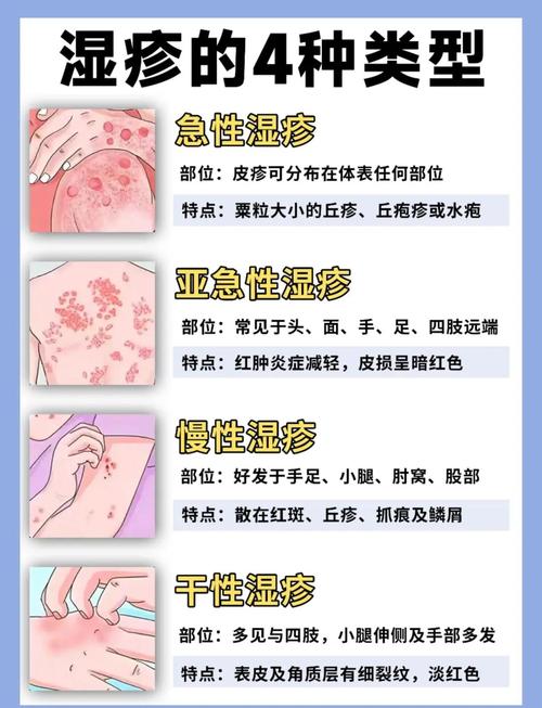 孕期湿疹发作难受，用盐水洗能缓解还是加重风险？-第3张图片-郑州医学网