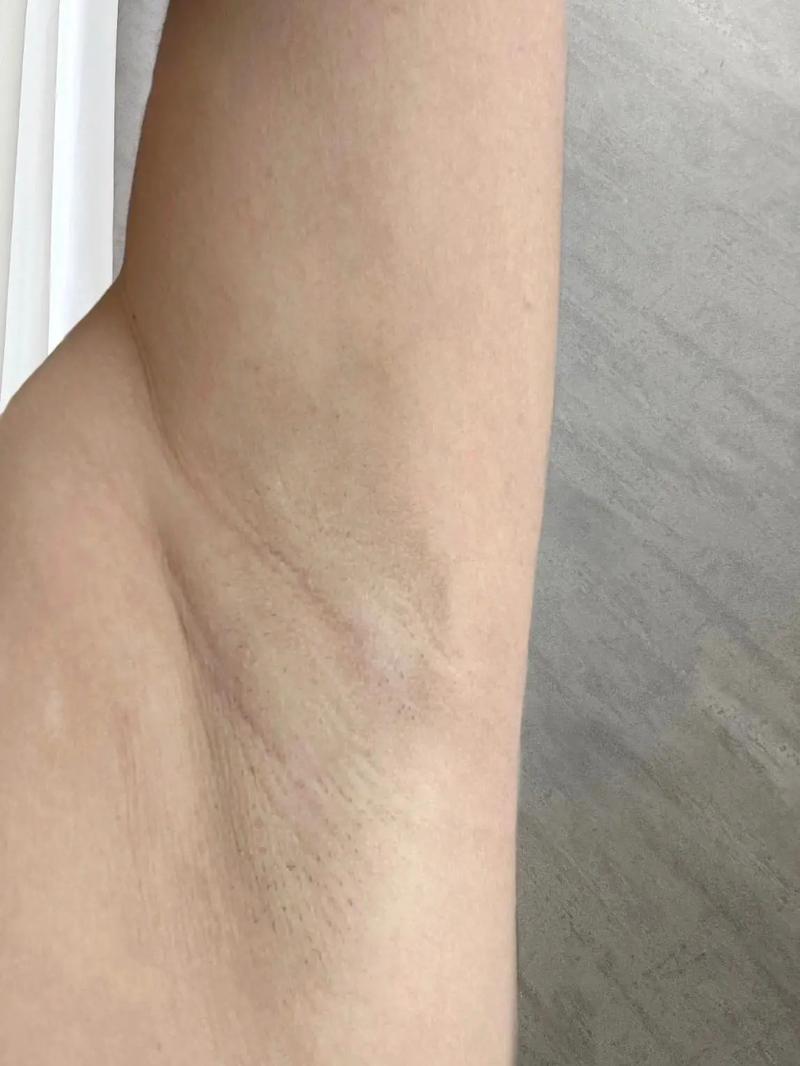 孕期腋窝变黑与胎儿性别有关？科学依据是什么？-第2张图片-郑州医学网