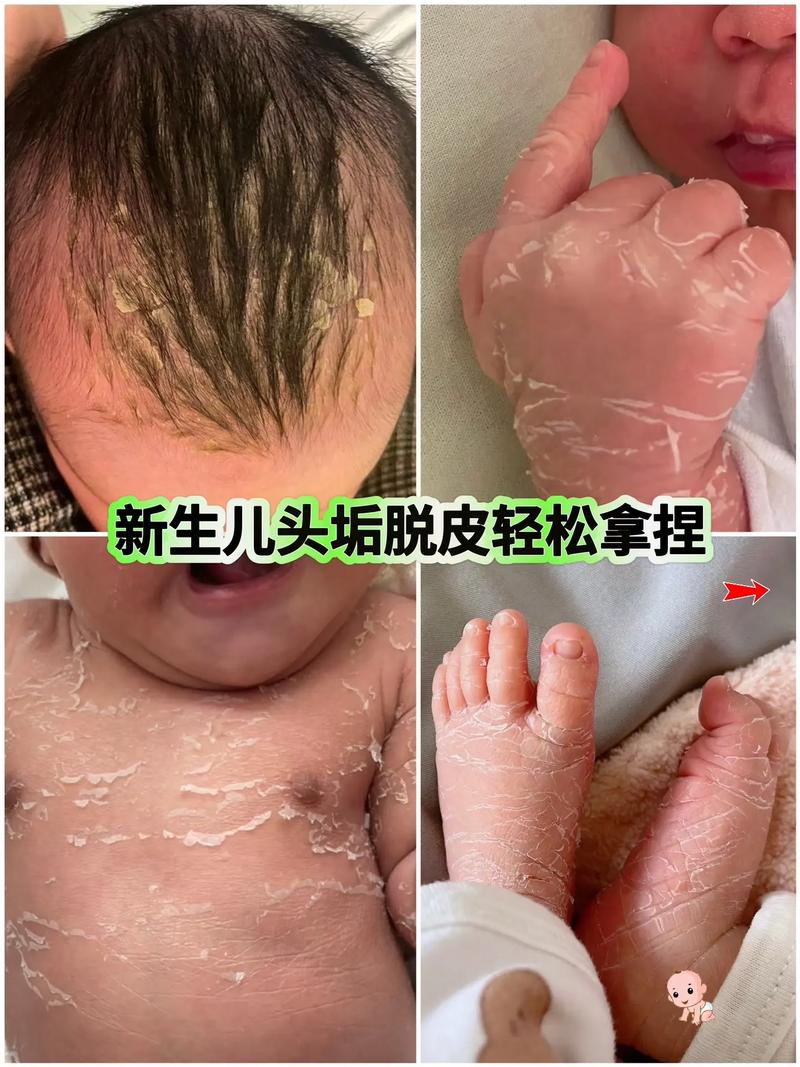 新生儿脚脱皮是正常生理现象还是疾病信号?需要特别护理吗?-第1张图片-郑州医学网 新生儿脚脱皮是正常生理现象还是疾病信号?需要特别护理吗?-第1张图片-郑州医学网