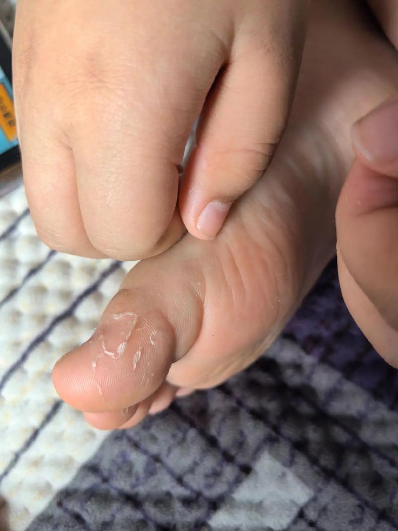 新生儿脚脱皮是正常生理现象还是疾病信号？需要特别护理吗？-第2张图片-郑州医学网