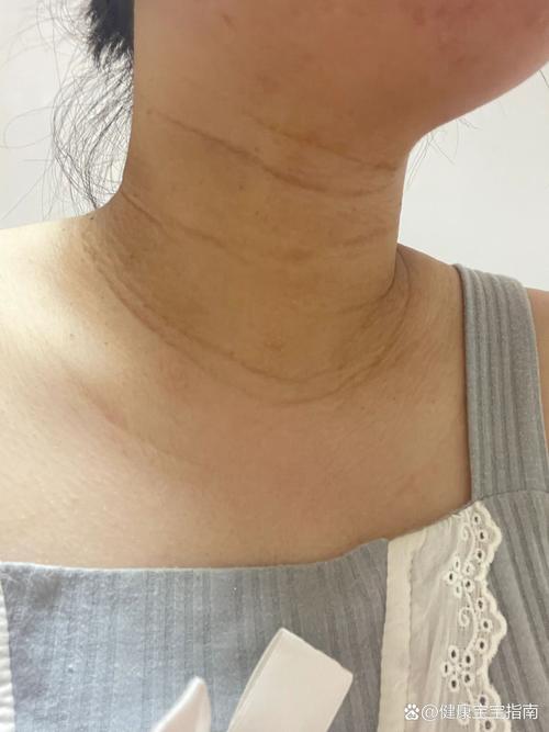 孕期脖子变黑会自己慢慢恢复吗？需要做些什么来加速改善呢？-第2张图片-郑州医学网