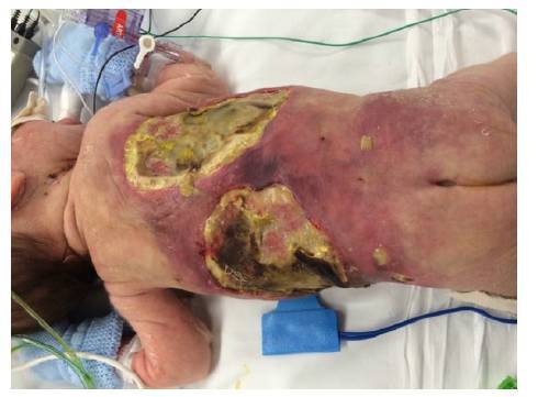 新生儿感染金黄葡萄球菌有哪些症状与风险?如何有效预防与治疗?-第1张图片-郑州医学网 新生儿感染金黄葡萄球菌有哪些症状与风险?如何有效预防与治疗?-第1张图片-郑州医学网