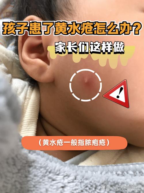 新生儿感染金黄葡萄球菌有哪些症状与风险?如何有效预防与治疗?-第3张图片-郑州医学网 新生儿感染金黄葡萄球菌有哪些症状与风险?如何有效预防与治疗?-第3张图片-郑州医学网