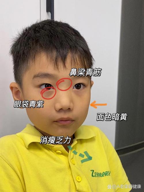 新生儿眼眶发青是正常现象还是疾病信号?需关注哪些潜在原因?-第3张图片-郑州医学网 新生儿眼眶发青是正常现象还是疾病信号?需关注哪些潜在原因?-第3张图片-郑州医学网