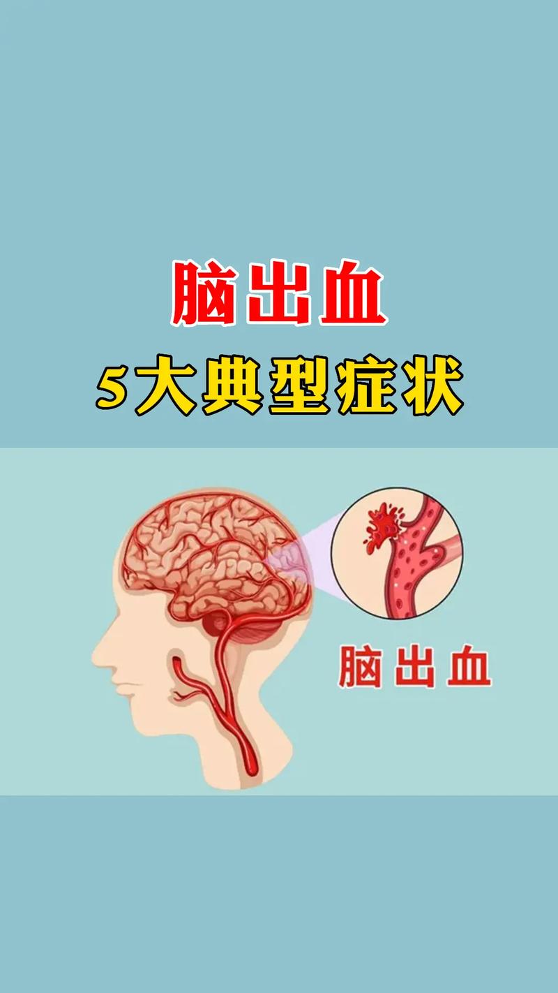 新生儿颅内出血的临床表现有哪些具体特征及早期识别要点？-第2张图片-郑州医学网