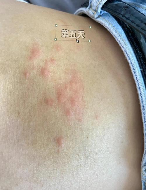 孕期带状疱疹图片大全，孕期感染带状疱疹的图片有哪些症状表现？-第1张图片-郑州医学网