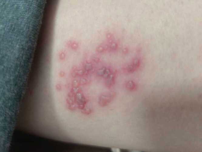 孕期带状疱疹图片大全，孕期感染带状疱疹的图片有哪些症状表现？-第2张图片-郑州医学网