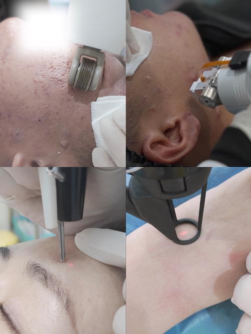 备孕期能做激光美容吗？激光美容对胎儿有影响吗？-第2张图片-郑州医学网