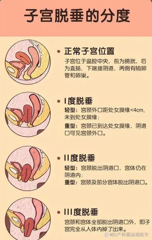 孕期子宫脱垂会有哪些明显症状？对母婴健康有何影响？-第1张图片-郑州医学网