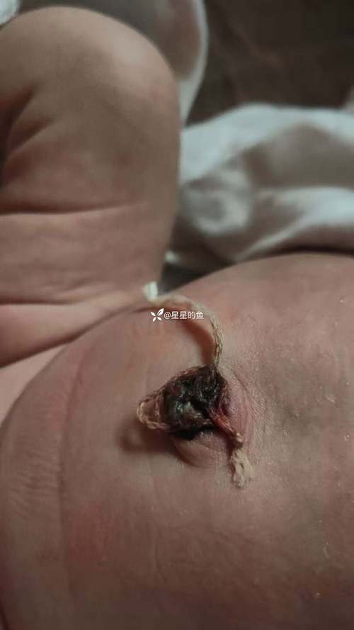 新生儿脐带出血是正常现象还是异常信号？该如何正确处理与护理？-第3张图片-郑州医学网