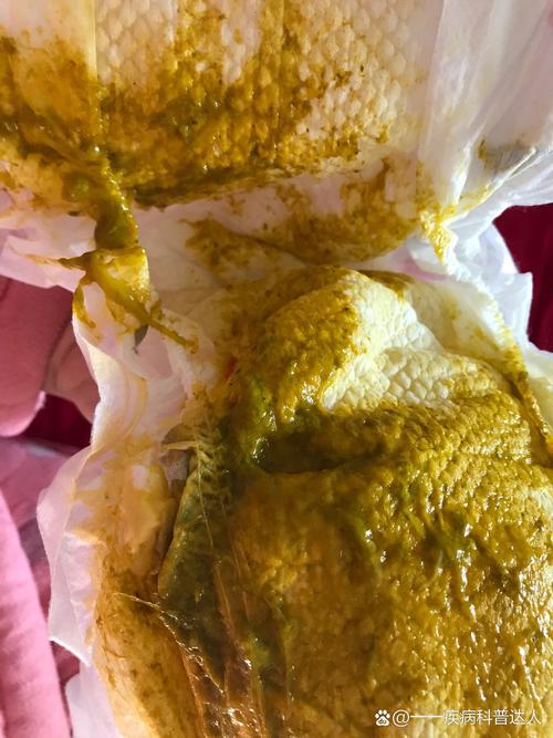 儿童大便出现白色粘稠物是消化问题还是感染信号？-第2张图片-郑州医学网