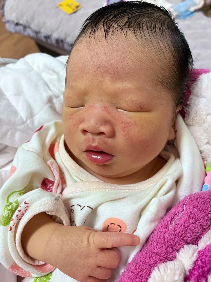 新生儿黄疸高时，宝宝会出现哪些具体症状？家长该如何早期识别？-第2张图片-郑州医学网