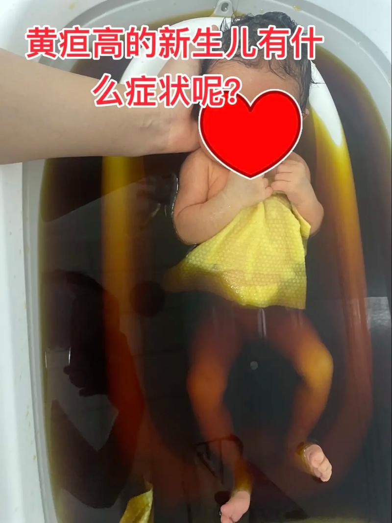 新生儿黄疸高时,宝宝会出现哪些具体症状?家长该如何早期识别?-第1张图片-郑州医学网 新生儿黄疸高时,宝宝会出现哪些具体症状?家长该如何早期识别?-第1张图片-郑州医学网