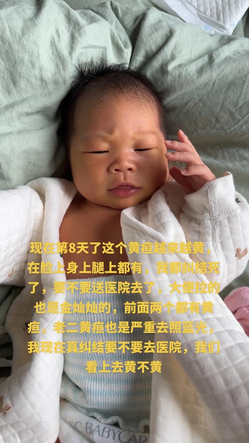 新生儿黄疸高时，宝宝会出现哪些具体症状？家长该如何早期识别？-第3张图片-郑州医学网