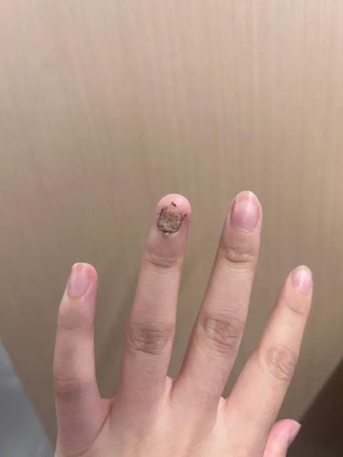 儿童指甲无故脱落是缺乏营养还是疾病信号？家长该如何应对？-第1张图片-郑州医学网