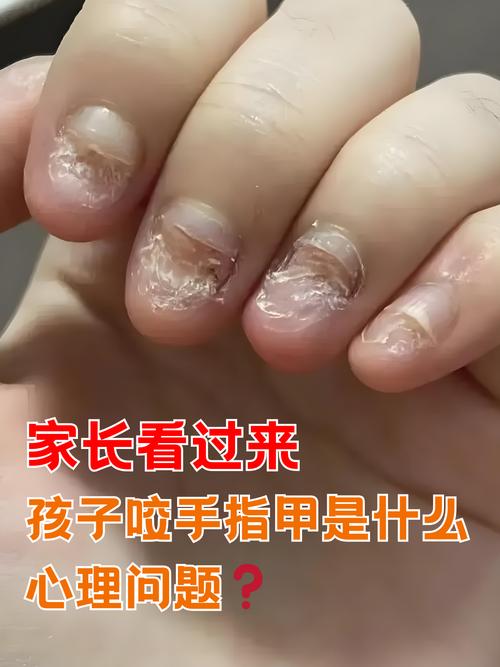 儿童指甲无故脱落是缺乏营养还是疾病信号？家长该如何应对？-第2张图片-郑州医学网