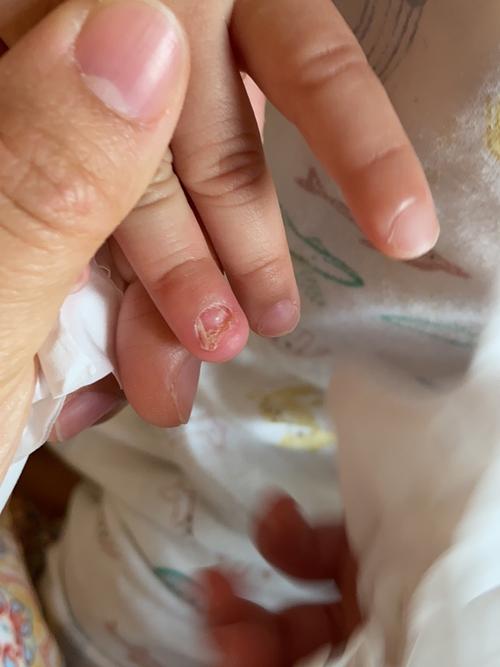 儿童指甲无故脱落是缺乏营养还是疾病信号？家长该如何应对？-第3张图片-郑州医学网