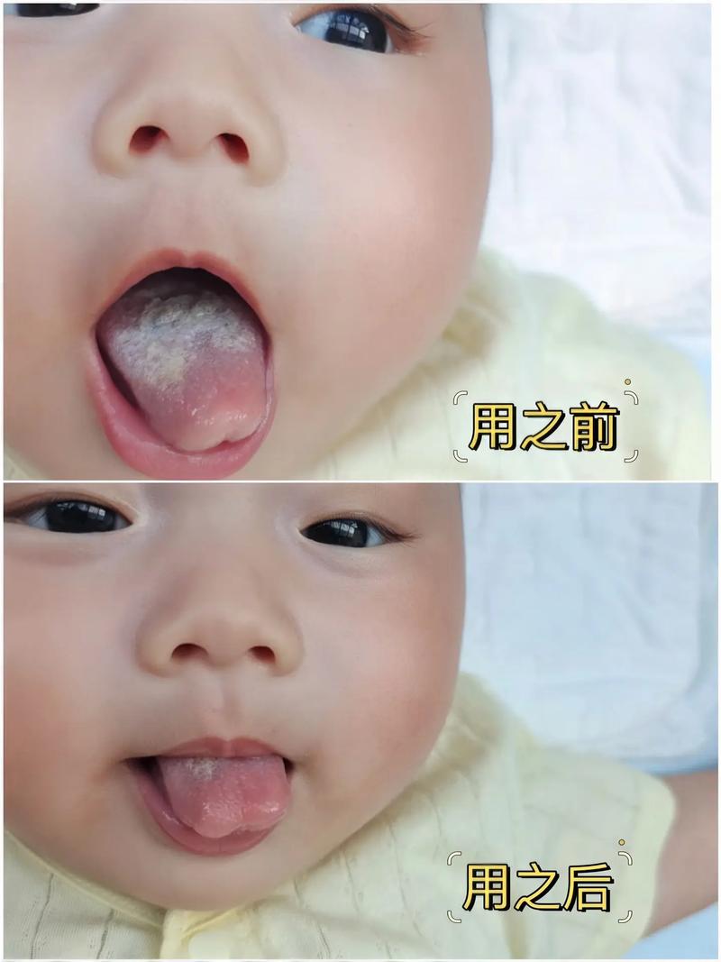 新生儿舌苔发白是正常现象还是健康预警？需要干预吗？-第3张图片-郑州医学网