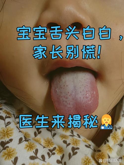 新生儿舌苔发白是正常现象还是健康预警？需要干预吗？-第2张图片-郑州医学网