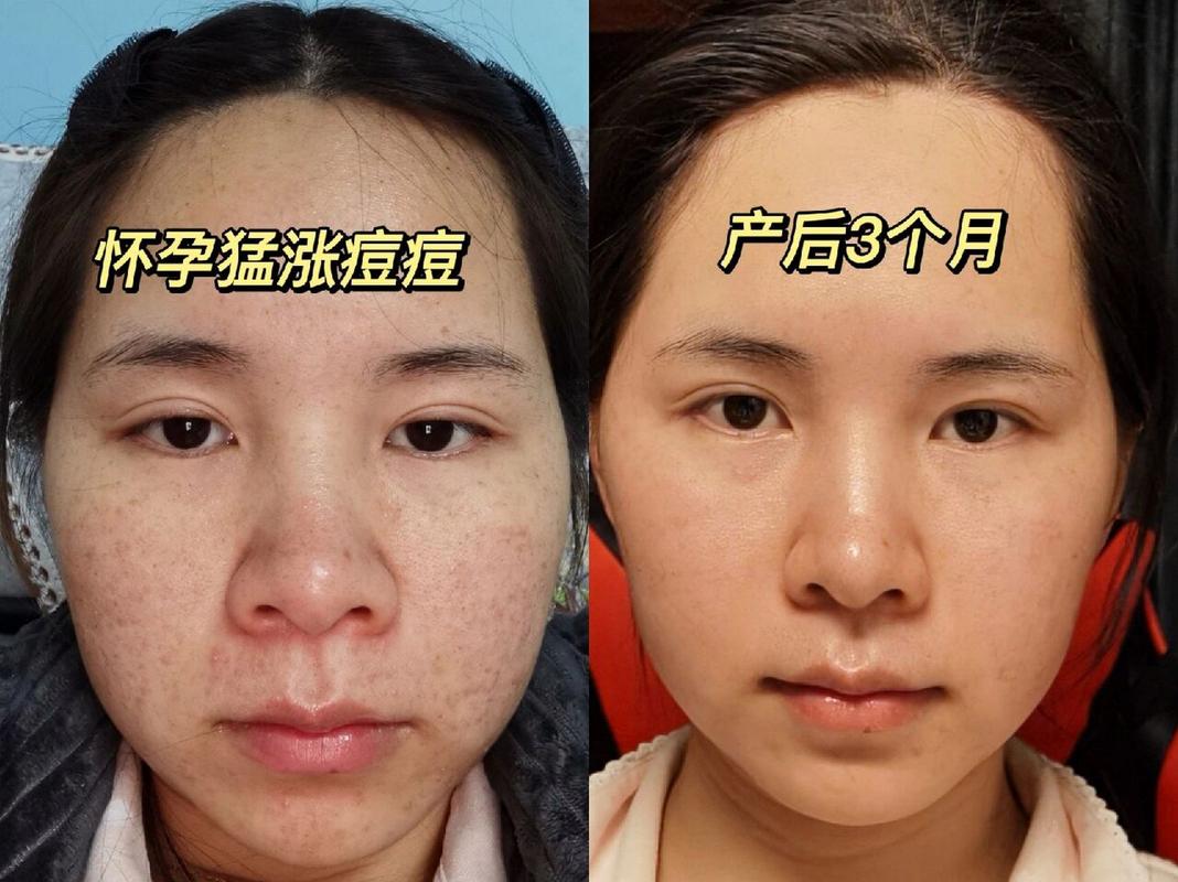 孕期脸上长痘，如何安全有效去除又不伤胎儿？-第3张图片-郑州医学网