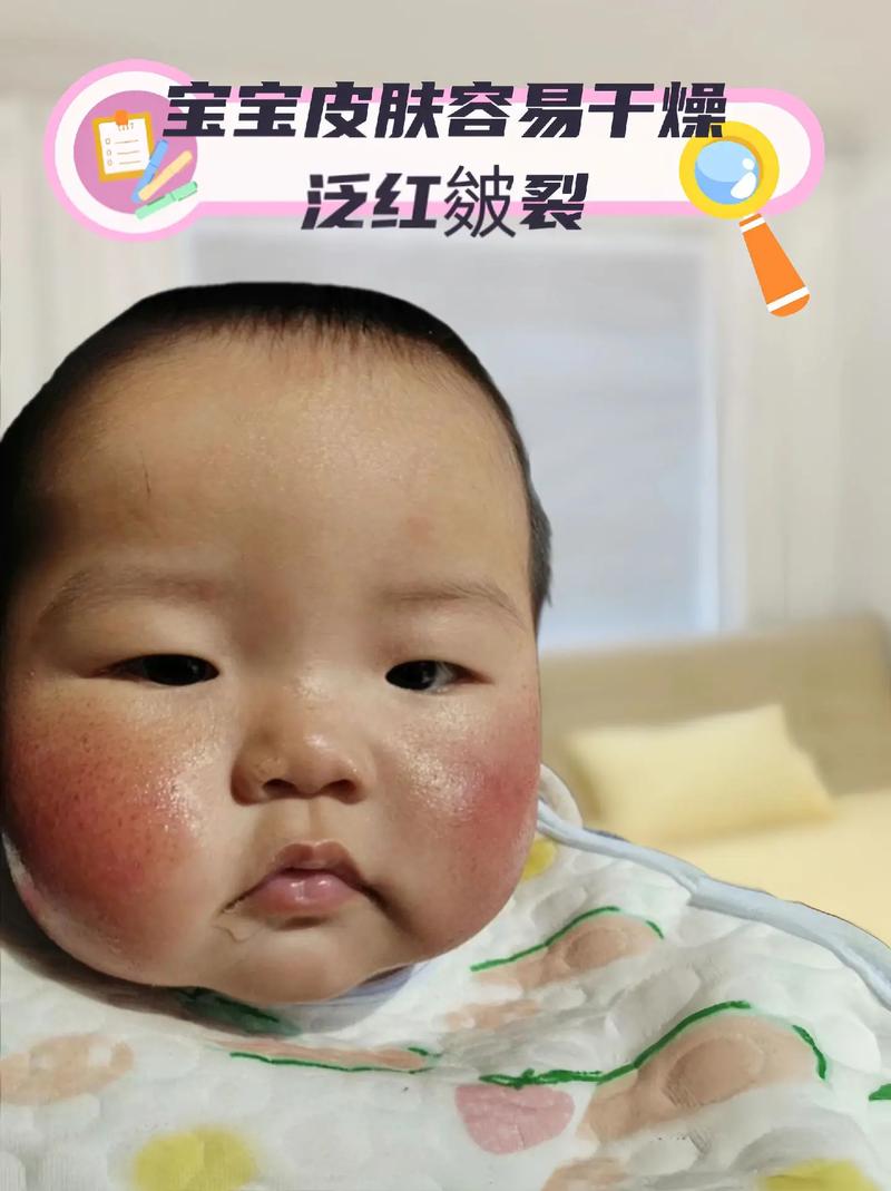 新生儿间接胆红素300μmol/L严重吗？需要立即蓝光治疗吗？-第3张图片-郑州医学网