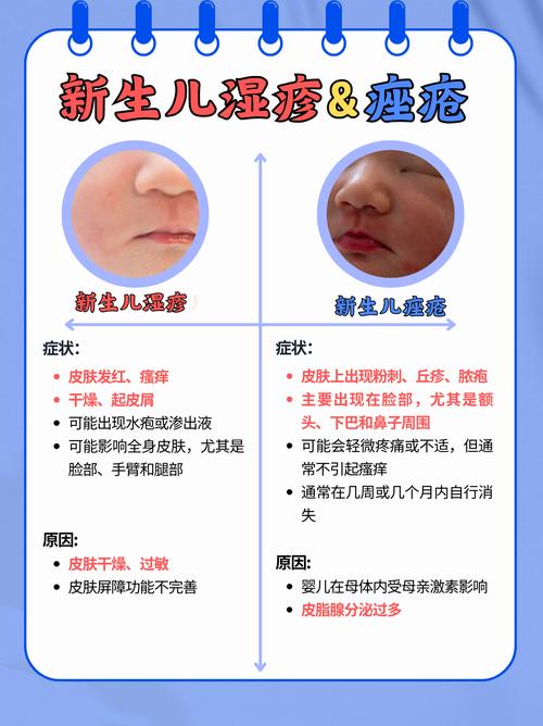 新生儿痤疮和湿疹的区别到底在哪里？家长该如何准确区分并科学护理？-第2张图片-郑州医学网