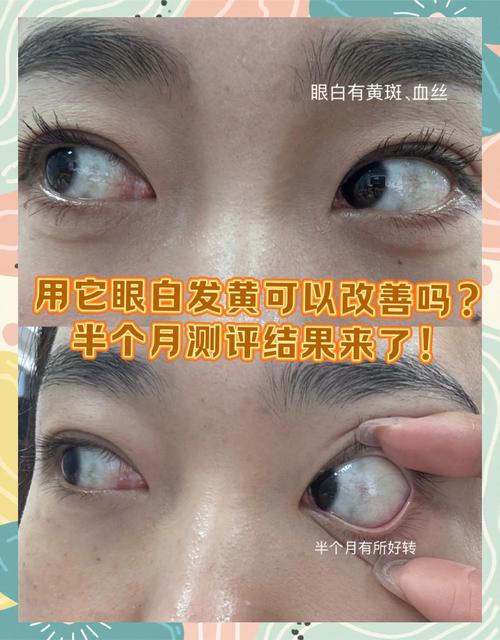 新生儿眼球发黄是黄疸吗？需要警惕哪些潜在问题？-第2张图片-郑州医学网