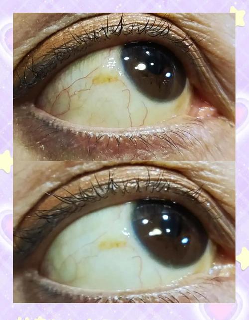 新生儿眼球发黄是黄疸吗？需要警惕哪些潜在问题？-第3张图片-郑州医学网