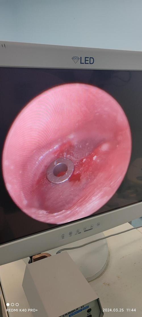 儿童鼓膜置管手术图解，全过程是怎样的？术后护理要注意什么？-第2张图片-郑州医学网