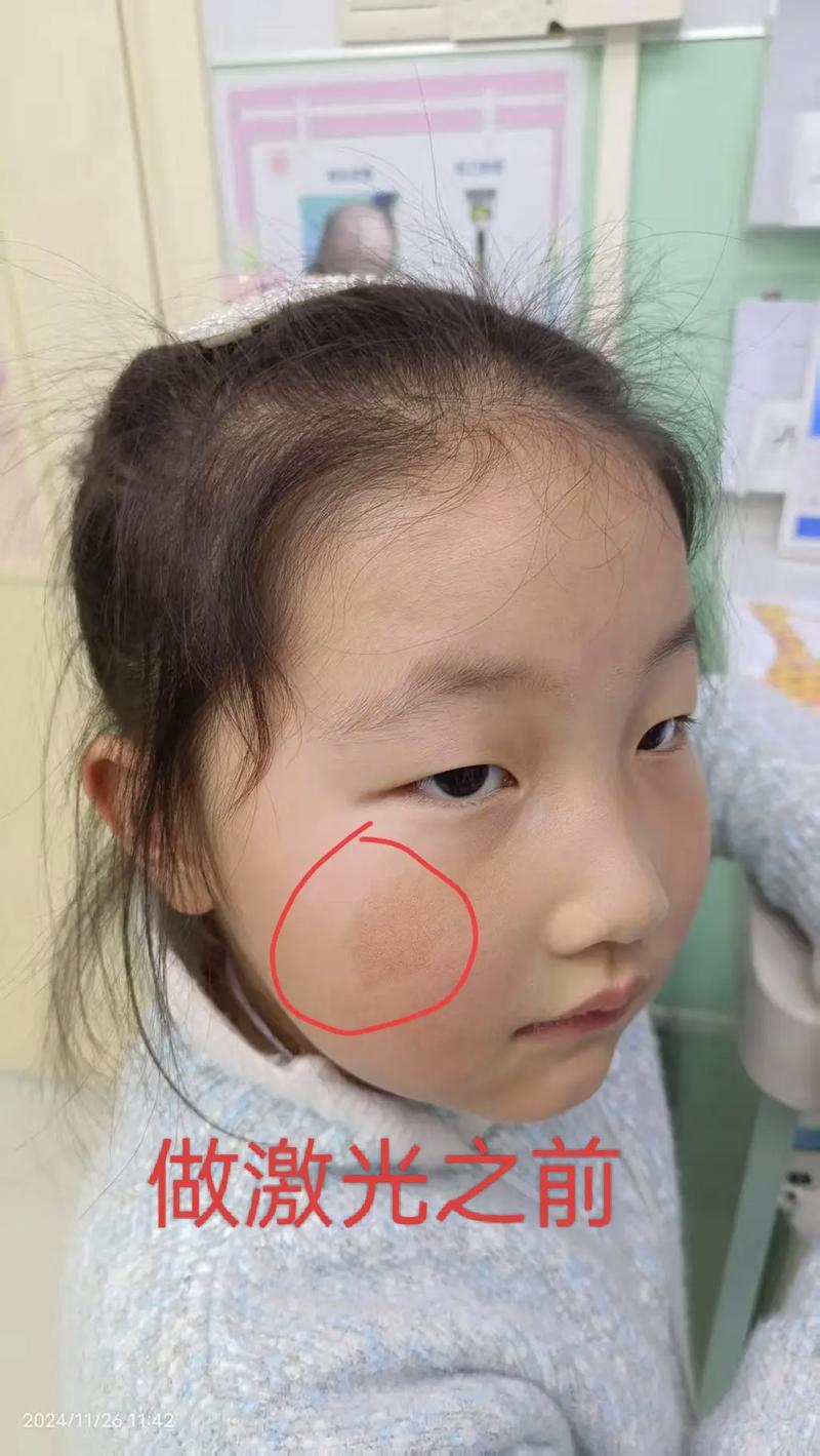 儿童祛斑最有效方法是什么？安全又无副作用的选择有哪些？-第1张图片-郑州医学网