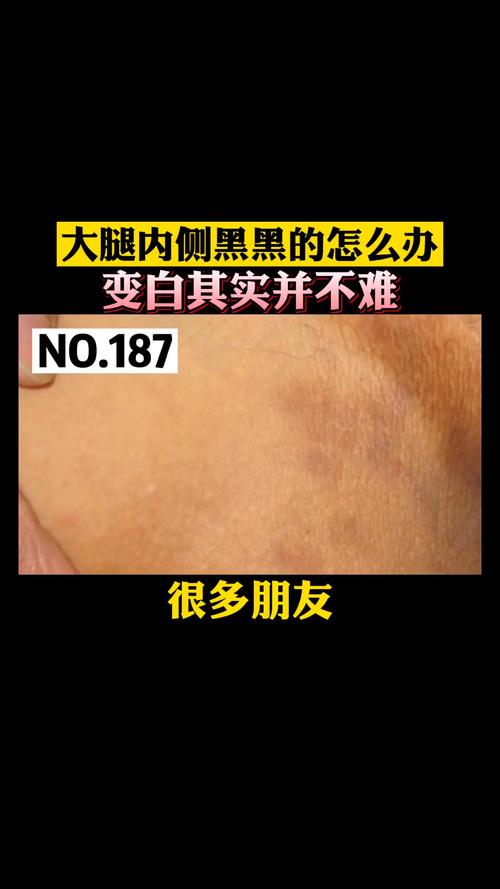 孕期大腿根内侧变黑是正常现象吗？需要担心或处理吗？-第1张图片-郑州医学网