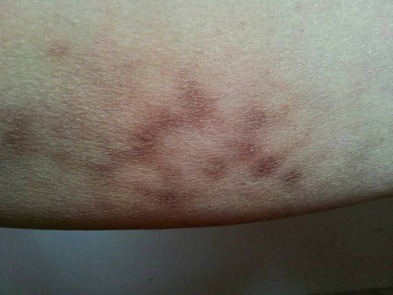 孕期大腿根内侧变黑是正常现象吗？需要担心或处理吗？-第2张图片-郑州医学网