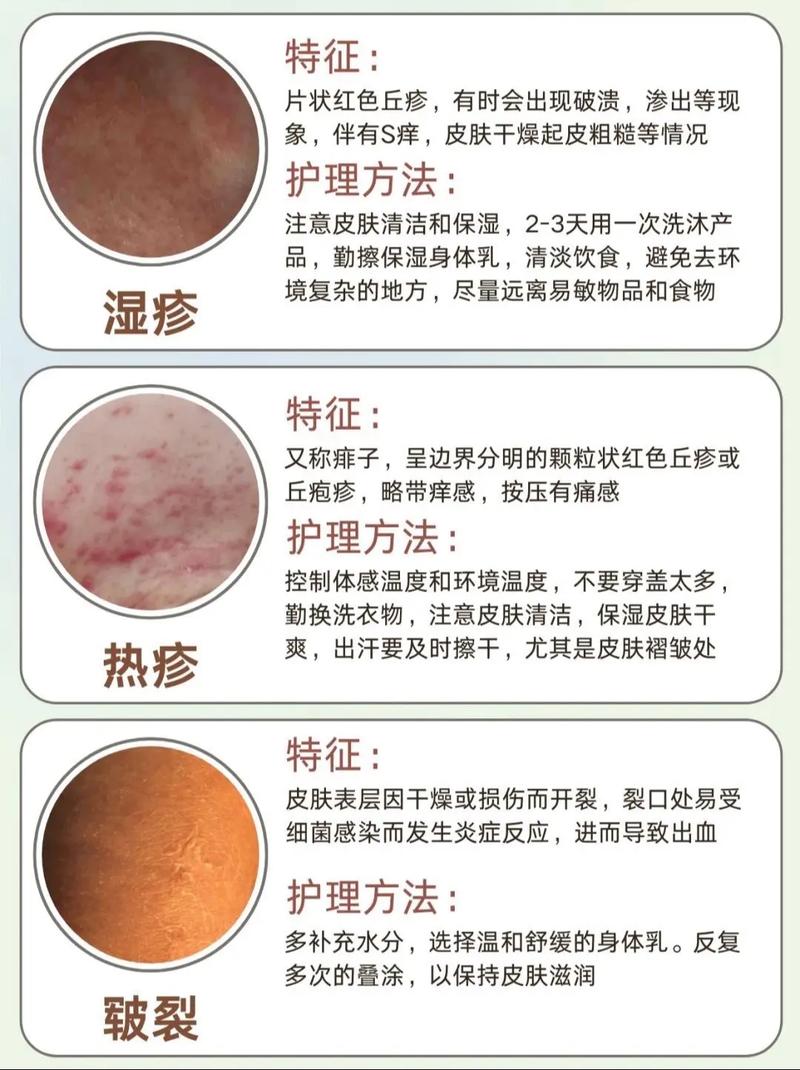 新生儿湿疹反复发作怎么办？日常护理与药物选择有哪些科学方法？-第2张图片-郑州医学网
