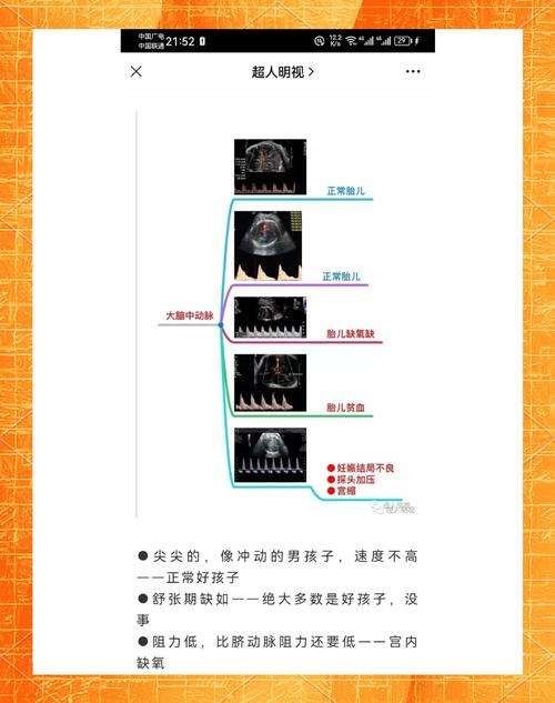 新生儿大脑中动脉RI值偏高或偏低意味着什么？-第1张图片-郑州医学网