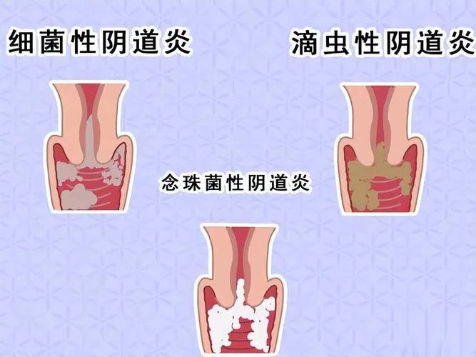 孕期外阴肿胀是什么原因造成的？需要担心吗？-第1张图片-郑州医学网