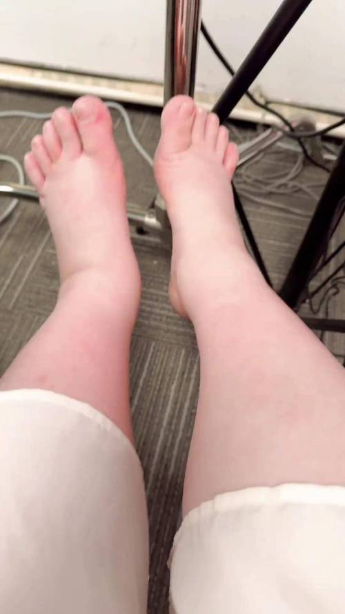 孕期外阴肿胀是什么原因造成的？需要担心吗？-第3张图片-郑州医学网