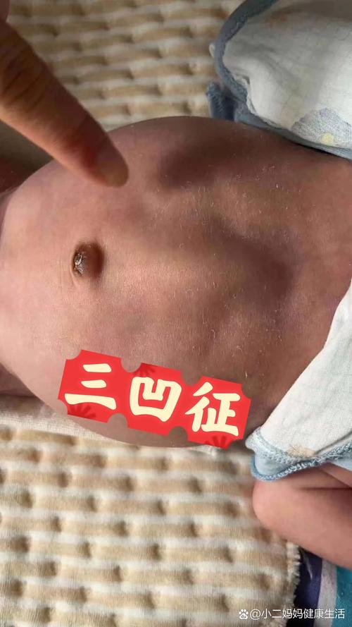 新生儿房间隔缺损3mm需要治疗吗？能自行愈合吗？对发育有影响吗？-第3张图片-郑州医学网