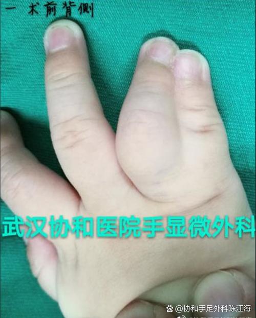 新生儿房间隔缺损3mm需要治疗吗？能自行愈合吗？对发育有影响吗？-第1张图片-郑州医学网