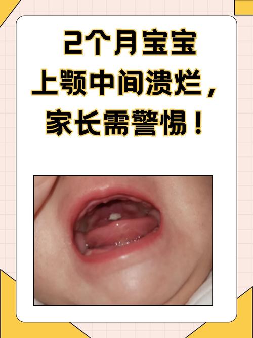 2mm新生儿房间隔缺损需要治疗吗？能自行愈合吗？需注意什么？-第2张图片-郑州医学网