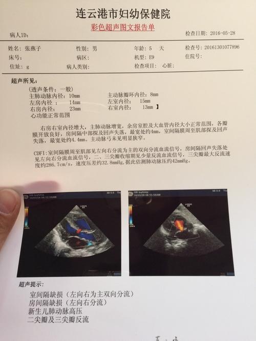 2mm新生儿房间隔缺损需要治疗吗？能自行愈合吗？需注意什么？-第3张图片-郑州医学网