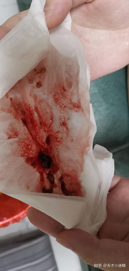 孕期胃酸吐血是紧急信号吗？需警惕哪些危险因素及应对措施？-第2张图片-郑州医学网