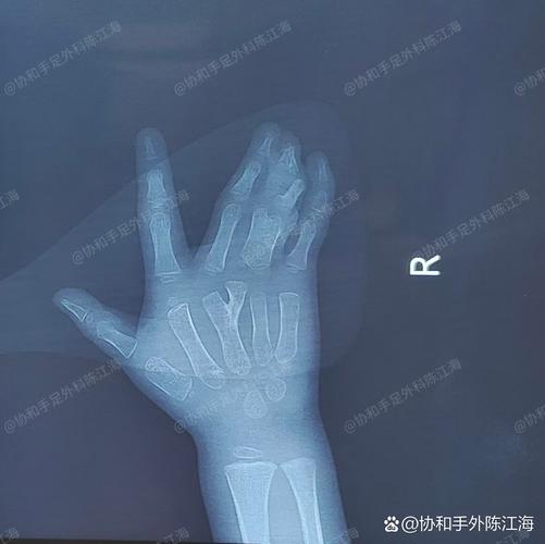 儿童DR检查辐射剂量到底有多大？会对身体造成潜在伤害吗？-第2张图片-郑州医学网