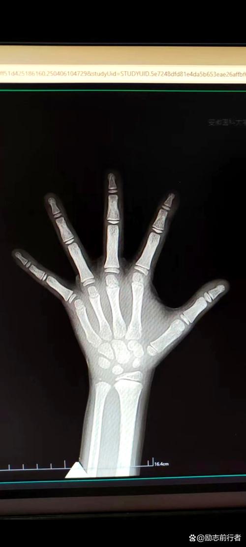 儿童DR检查辐射剂量到底有多大？会对身体造成潜在伤害吗？-第3张图片-郑州医学网