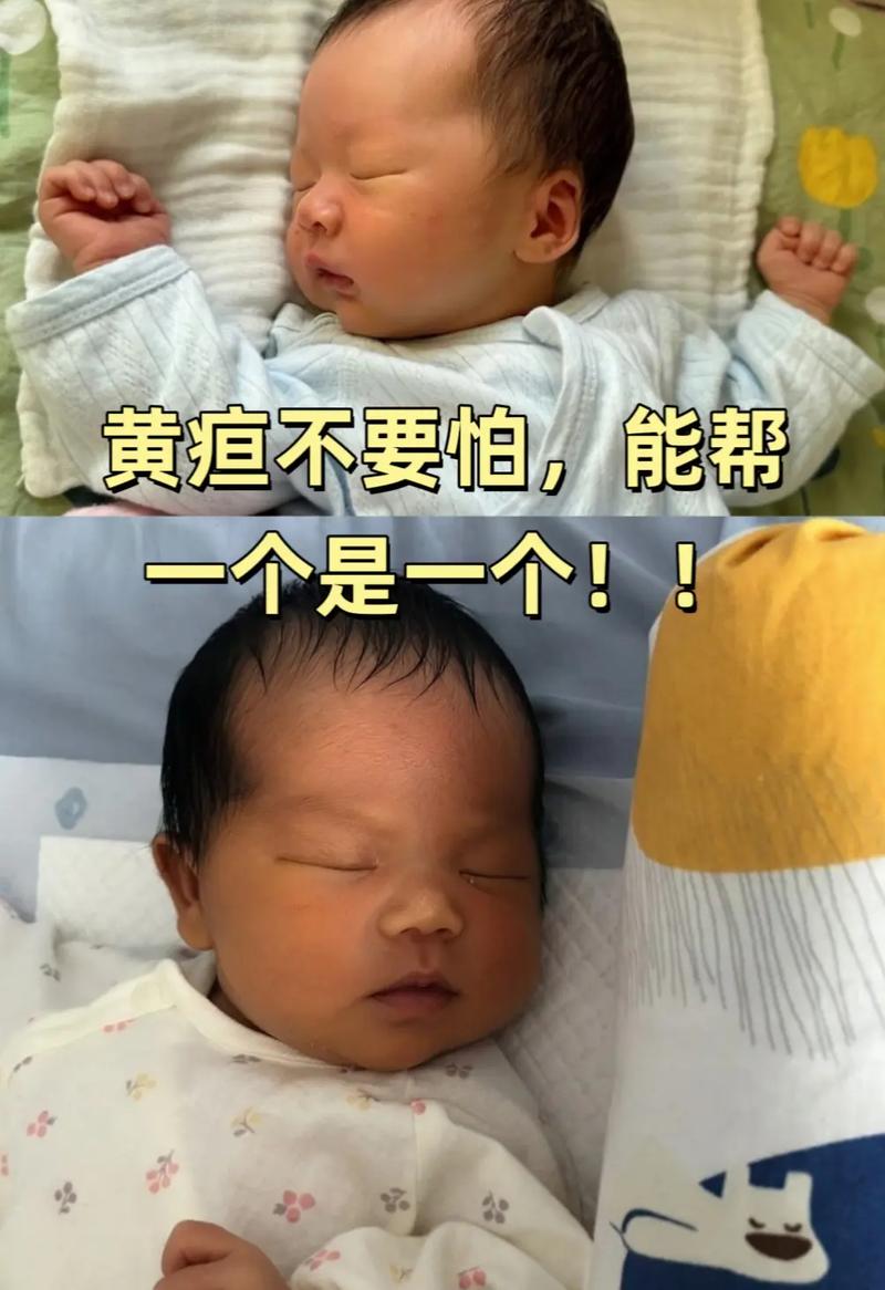 新生儿黄疸数值多少算高？如何判断是否需要就医干预？-第3张图片-郑州医学网