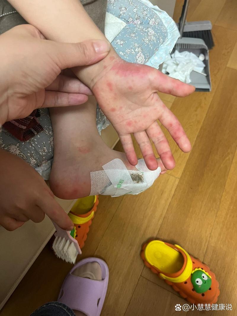 儿童手脚起红疹是过敏还是感染？家长该如何正确应对与护理？-第2张图片-郑州医学网