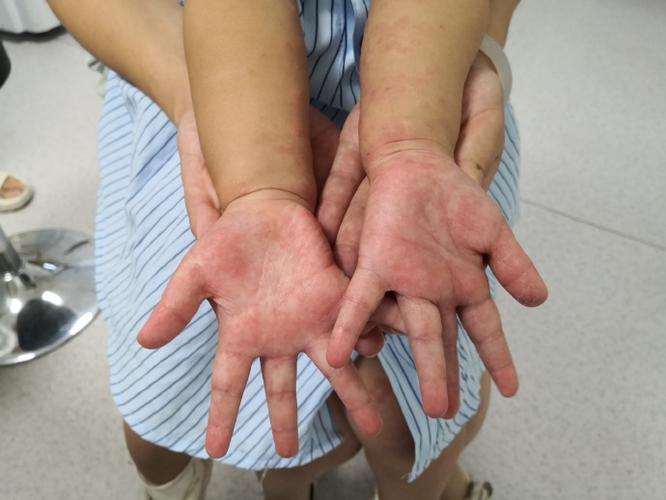 儿童手脚起红疹是过敏还是感染？家长该如何正确应对与护理？-第1张图片-郑州医学网
